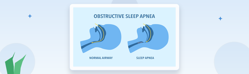Obstructive Sleep Apnea: Causes, Symptoms, Risk Factors & Treatment